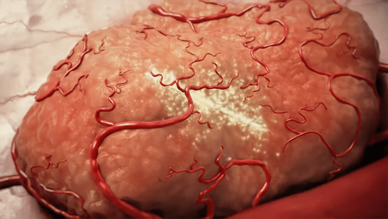 Alpha TAU Killing Tumors With Highly Targeted Alpha Radiation