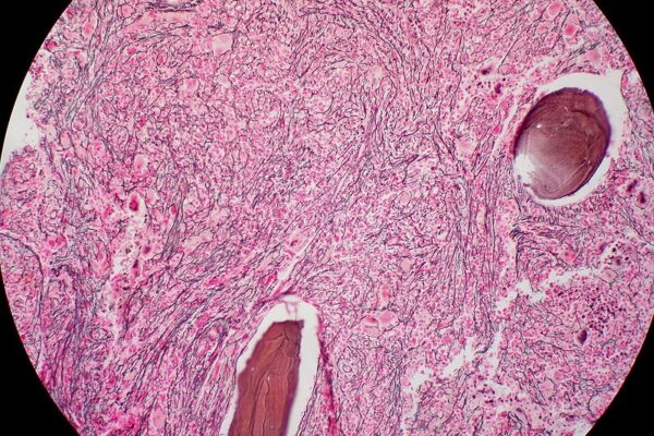 ‘Challenging Market’ Leads MorphoSys to Cut Preclinical R&D, Turn Focus to Cancer