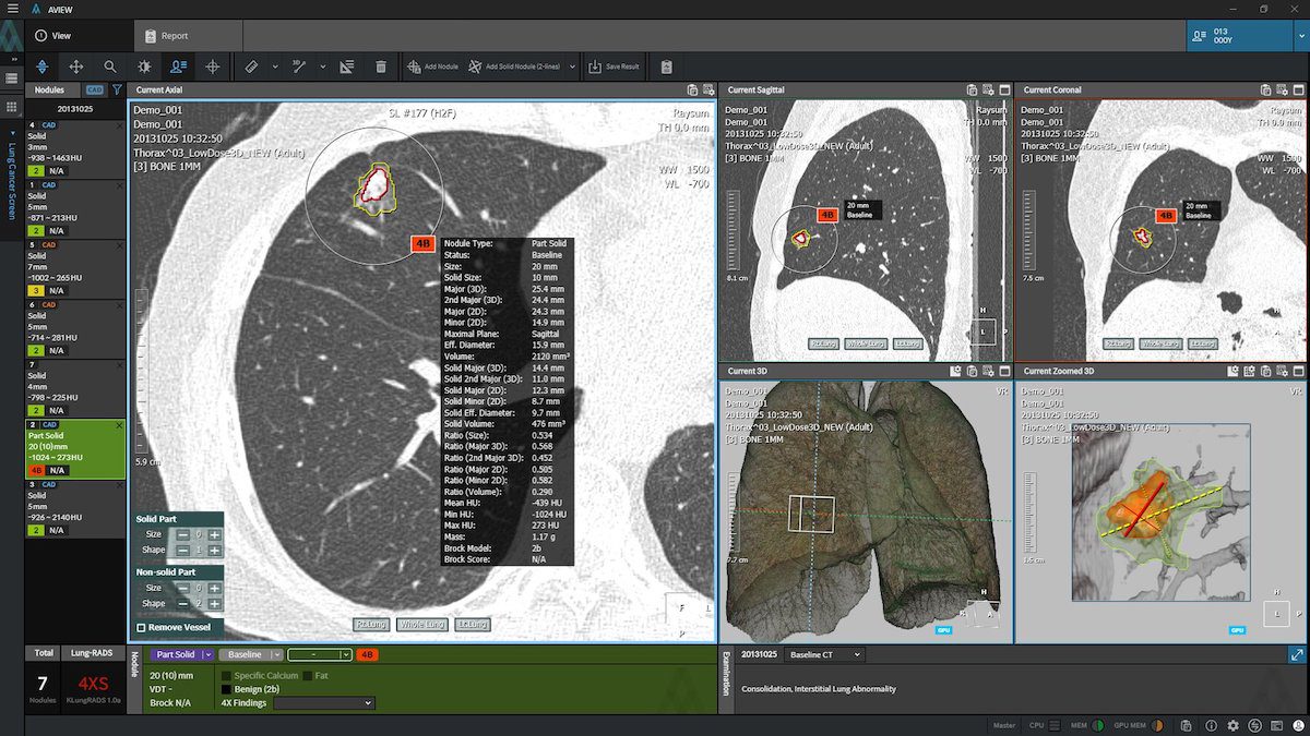 Coreline Soft bags FDA 510(k) for AI lung cancer detection software