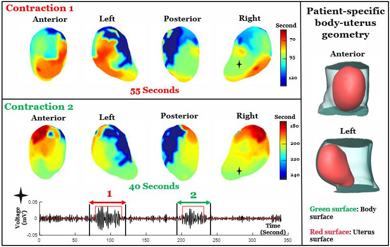 Imaging Technique Reveals Contraction Patterns During Labor