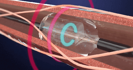 Ultrasound Catheter to Treat Hypertension