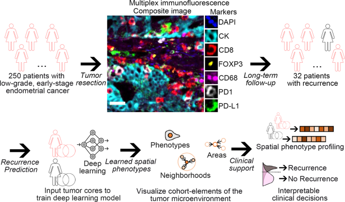 Weakly supervised deep learning to predict recurrence in low-grade endometrial cancer from multiplexed immunofluorescence images