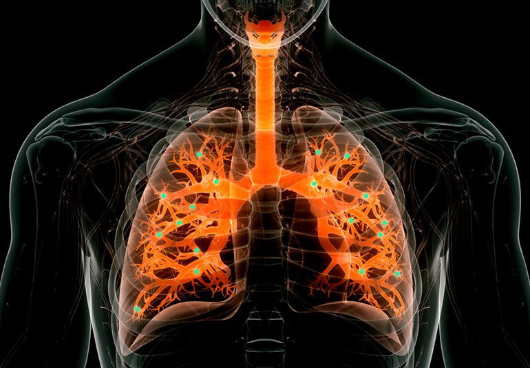 Nanoparticles Deliver mRNA Therapy to the Lungs