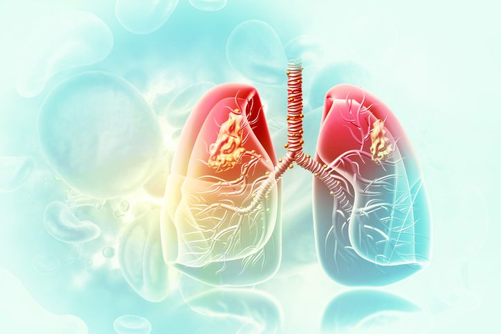 Noah Medical Rakes In $150M for Its Robotic Lung Biopsy Platform