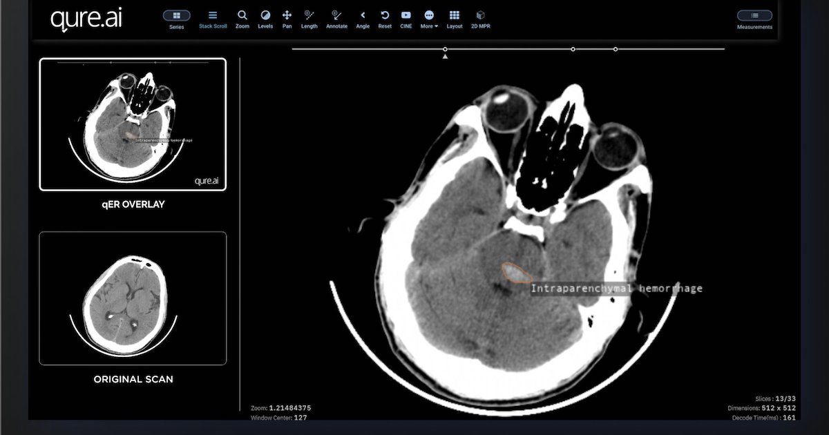 Qure.ai joins Medtronic India's stroke care initiative