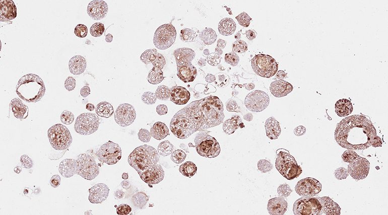 Cancer Organoids Offer Insights into Treatment Outcomes |