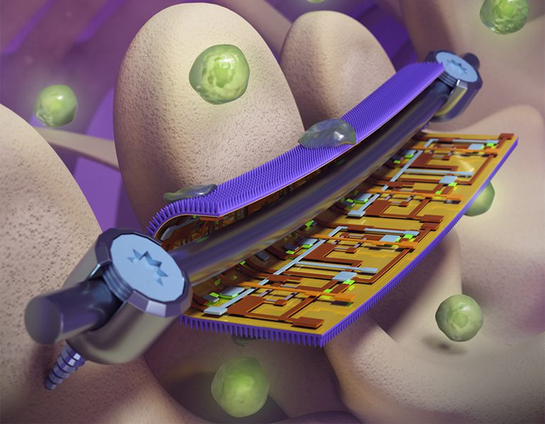 Implant Coating Fights Infection and Monitors Strain |