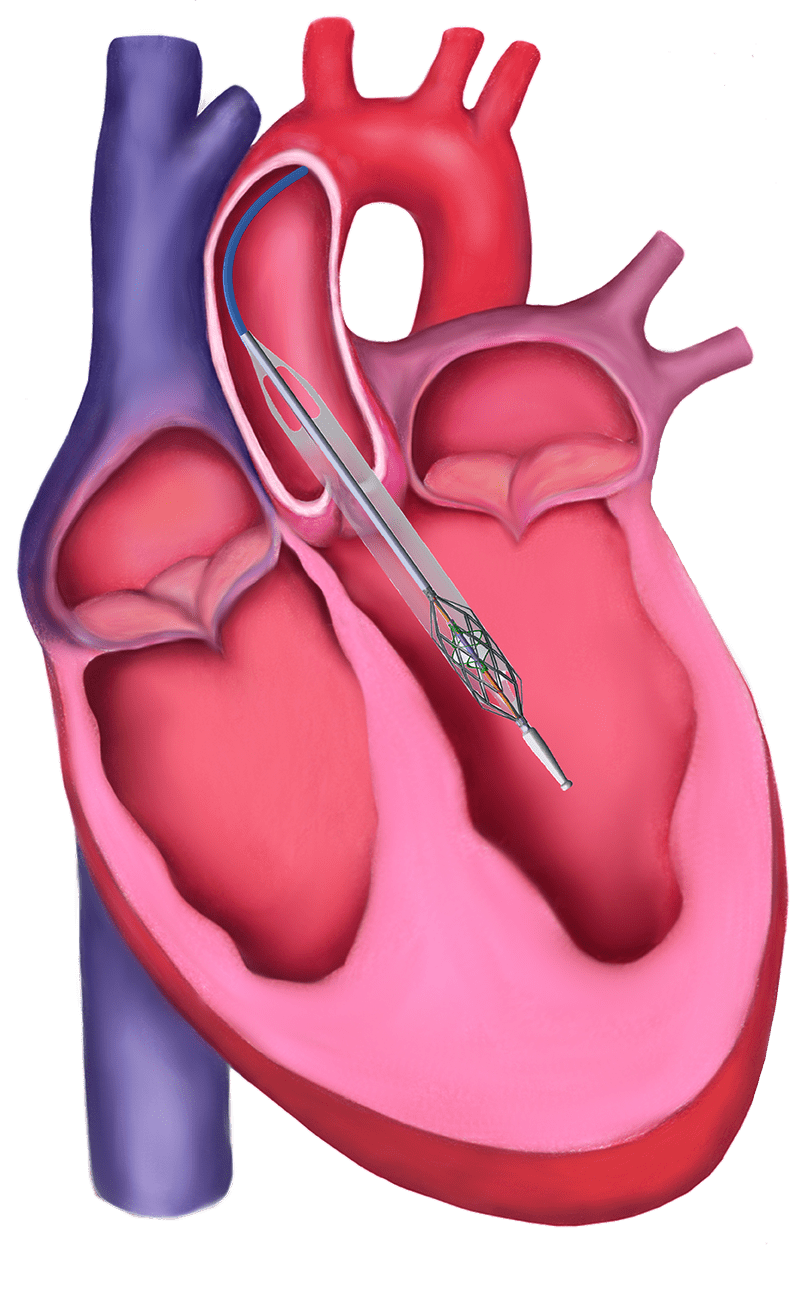 Magenta Medical Raises $55M for World’s Smallest Heart Pump