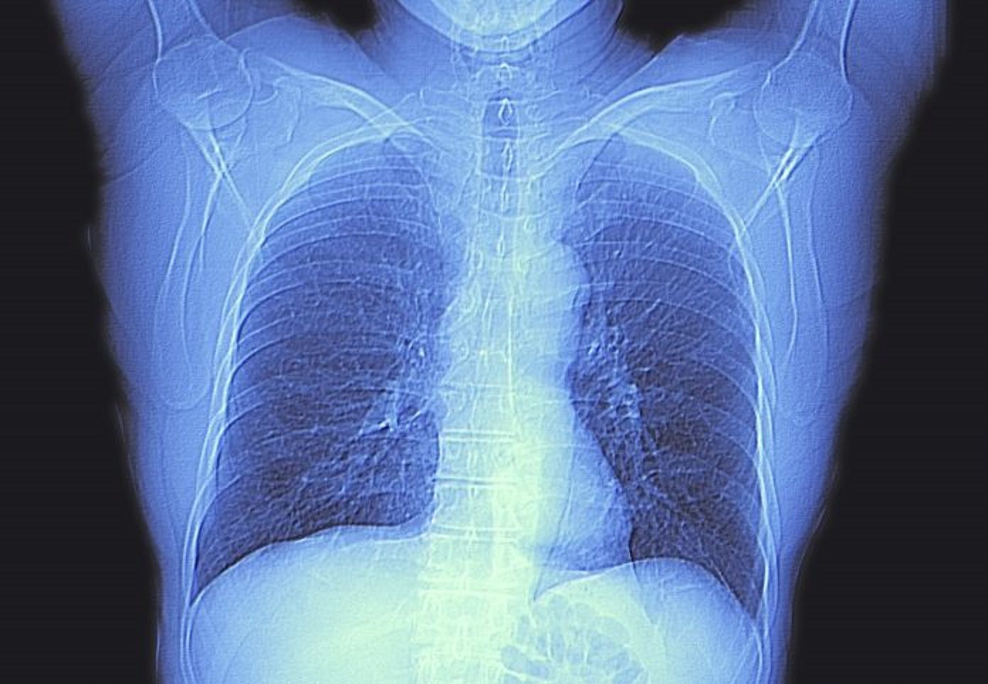 AI Utilizes Lung CT Data to Enhance Mortality Risk Prediction