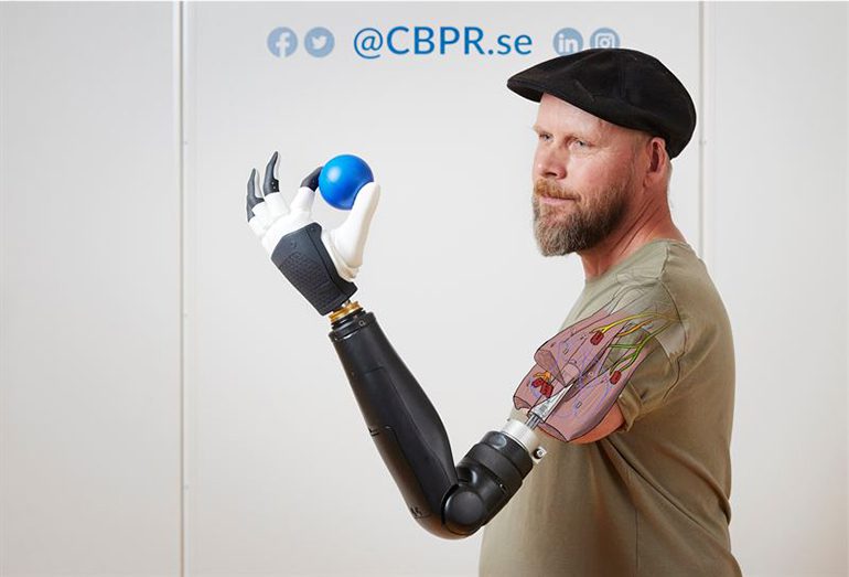 Above Elbow Amputee Controls Individual Bionic Fingers |