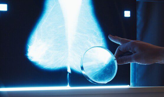AI can be used safely in breast cancer screening - Lancet study