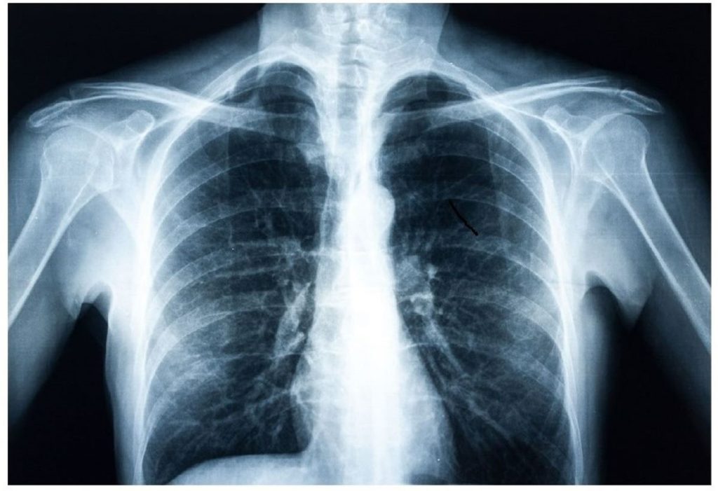 Cutting-Edge Deep Learning Algorithm Identifies Diabetes Risk from Routine Chest X-rays