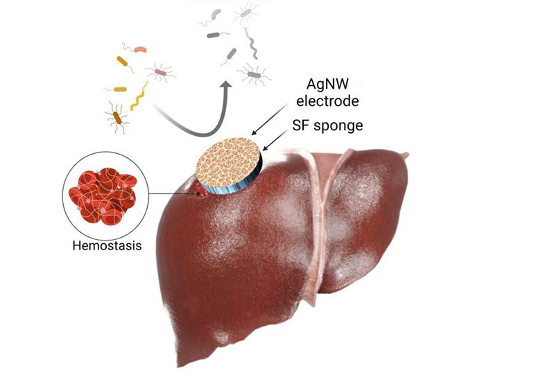 Implantable Sponge for Hemorrhage Monitoring and Control |