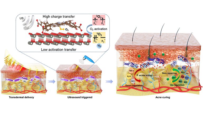 Microneedle Patch for Antibiotic-Free Acne Treatment |