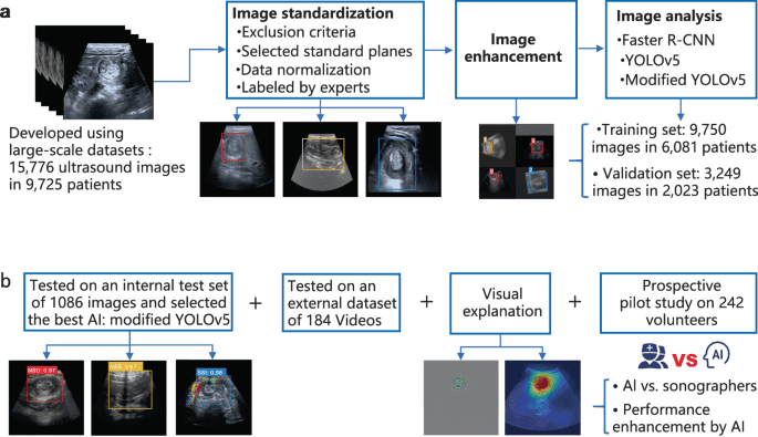 A deep-learning pipeline to diagnose pediatric intussusception and assess severity during ultrasound scanning: a multicenter retrospective-prospective study