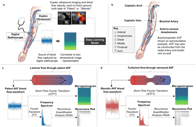 Deep learning analysis of blood flow sounds to detect arteriovenous fistula stenosis
