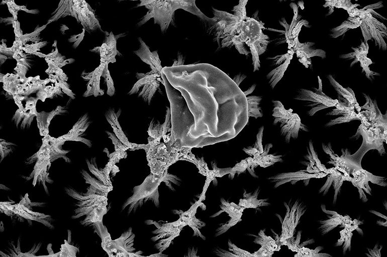 Etched Nanopillars Kill Bacteria, Fungi on Titanium Implants |