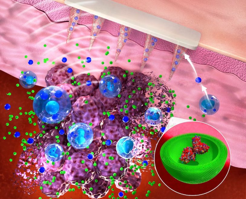 Microneedle Skin Patch Measures Cancer Biomarkers |