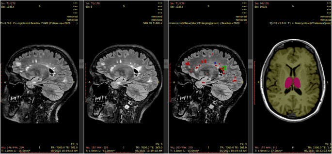A real-world clinical validation for AI-based MRI monitoring in multiple sclerosis