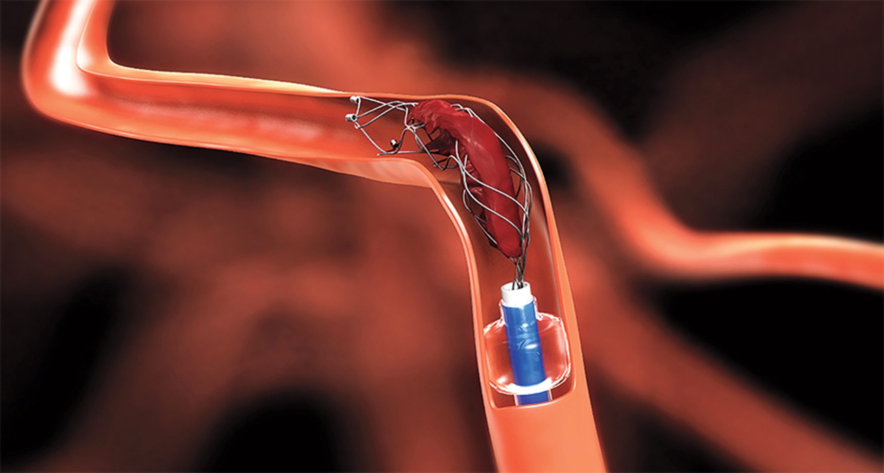 AI Blood Clot Tool Faces Clinician Hesitation