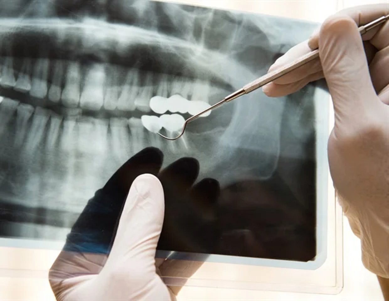 Advancing Radiography | Canon’s Intelligent Noise Reduction Breakthrough