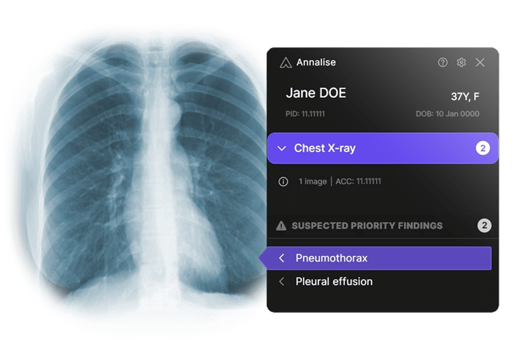 Annalise.ai Launches AI-Powered Worklist Triage for Chest X-Ray & Head CTs