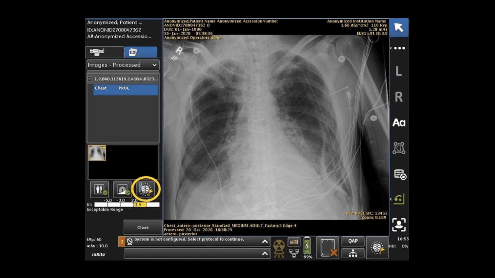 GE Healthcare Awarded FDA Clearance for Pneumothorax Detection Algorithm