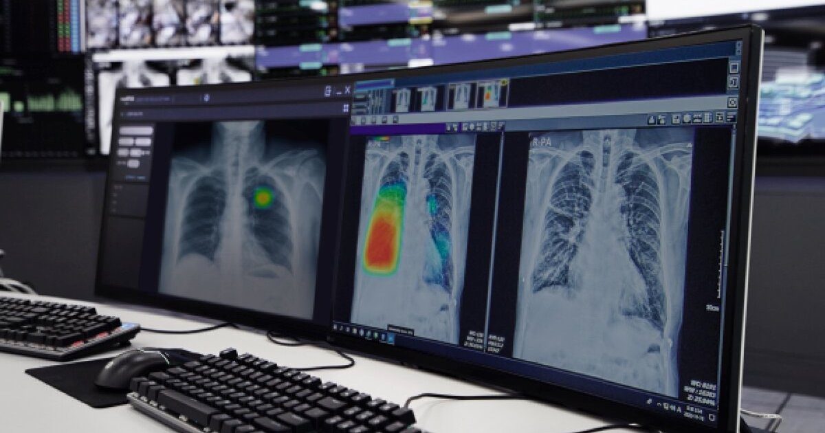 Growing adoption of AI CXR solution among APAC military hospitals and more briefs