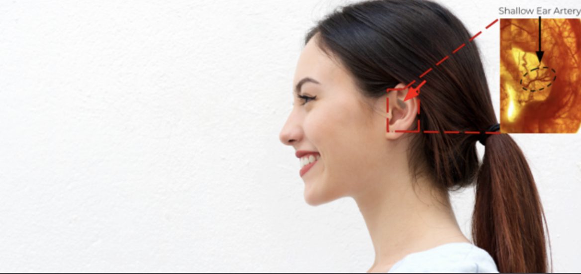 In-Ear Wearable Measures Blood Flow to the Head for Long COVID POTS