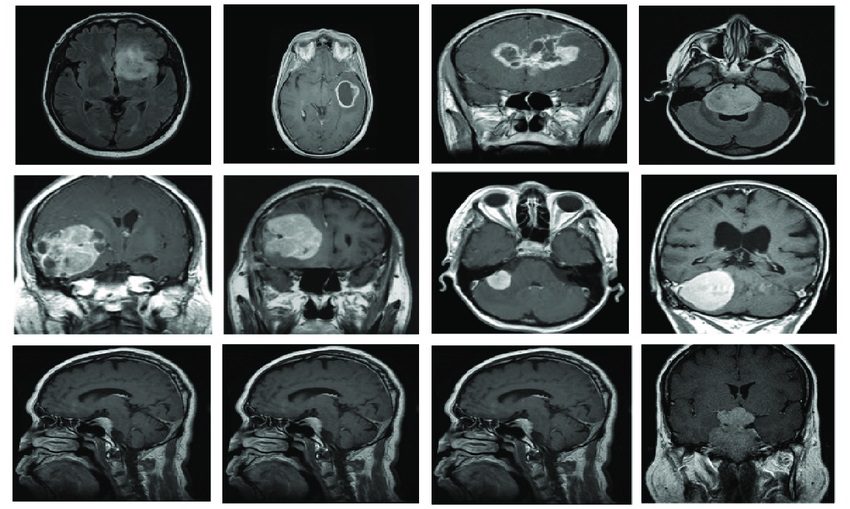ML Boosts Brain Tumor Analysis Advancing Meningioma Understanding