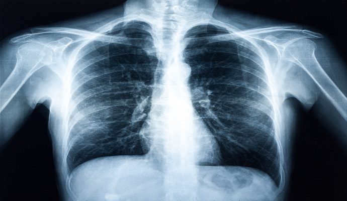 ML Model Estimates Chemotherapy Success in Bone Cancer Patients