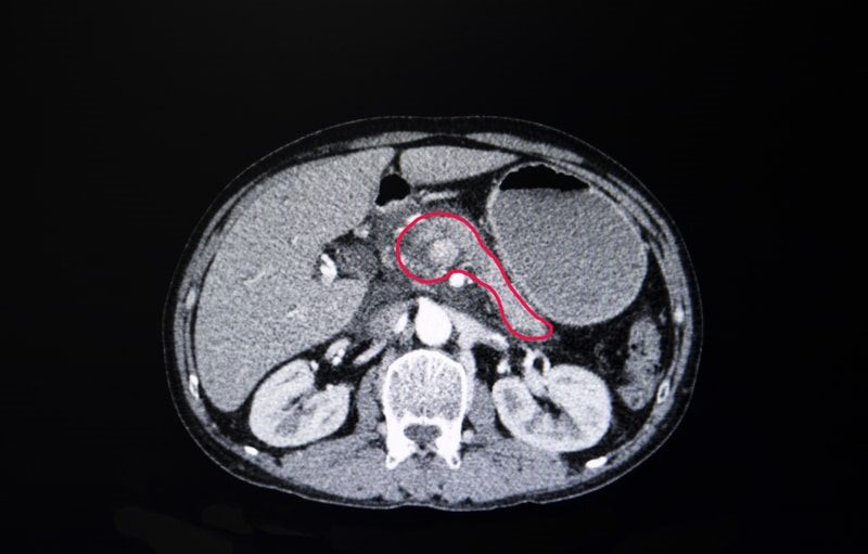 RSNA Award Honors AI’s Breakthrough in Pancreatic Cancer