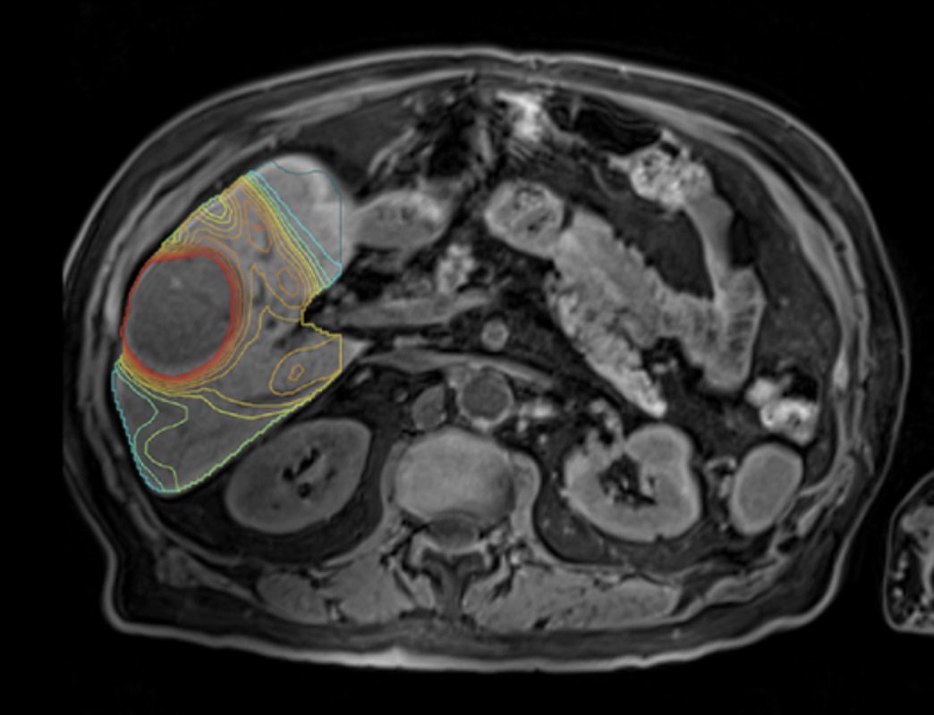 TeleDaaS Unveils Cutting-edge Cancer Treatment Breakthrough at RSNA 2023