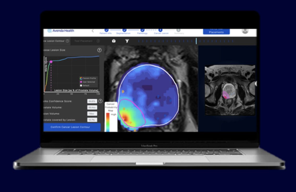 Unfold AI, AMA-Approved Mapping Tool for Prostate Cancer