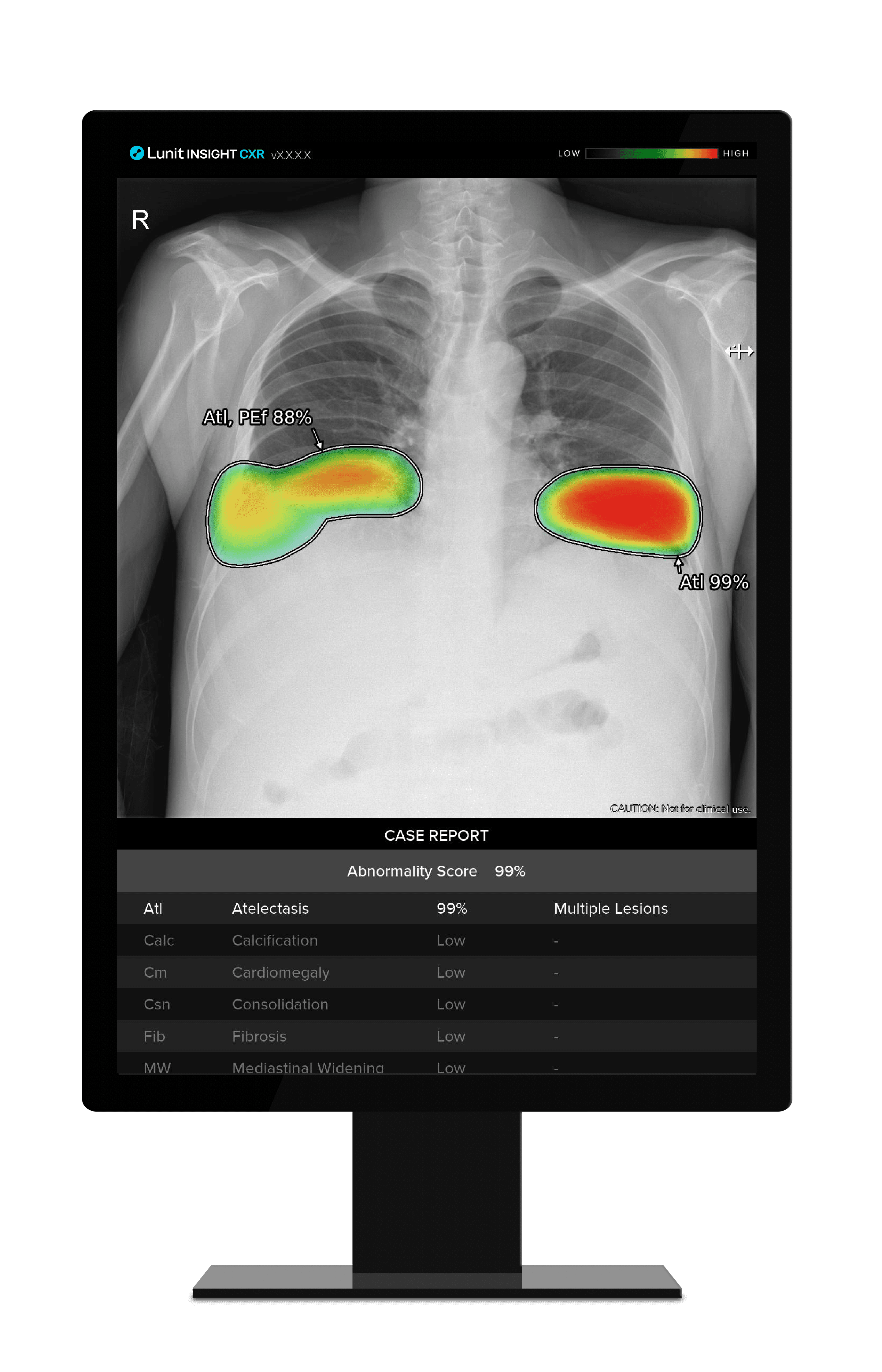Lunit and Samsung Integrate to Power AI-Powered Chest Screenings
