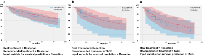 Machine learning-based clinical decision support system for treatment recommendation and overall survival prediction of hepatocellular carcinoma: a multi-center study