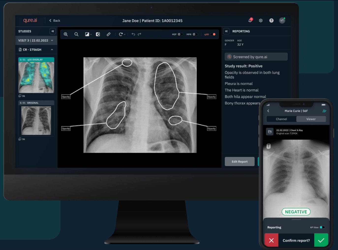 Qure.ai’s Breakthrough in Lung Nodule Detection | AI Innovations
