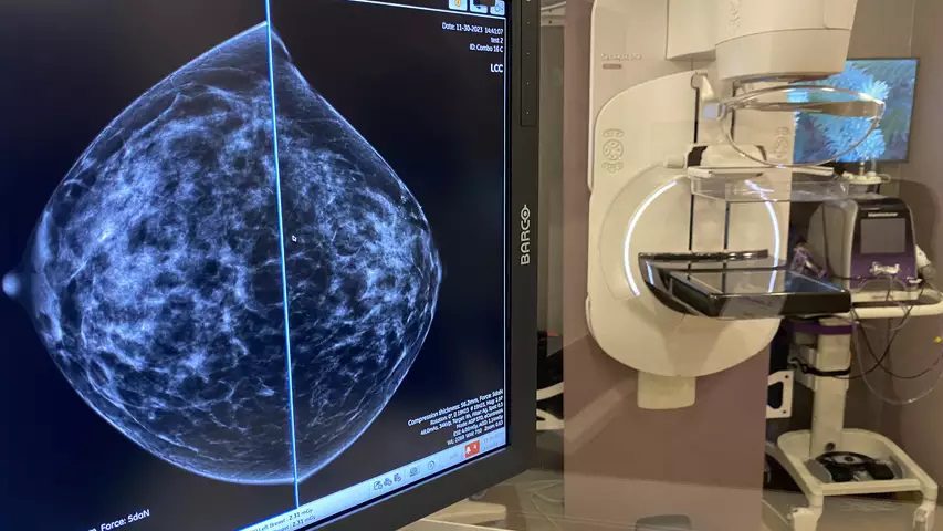 RSNA 2023 Unveils AI Revolution in Breast Imaging