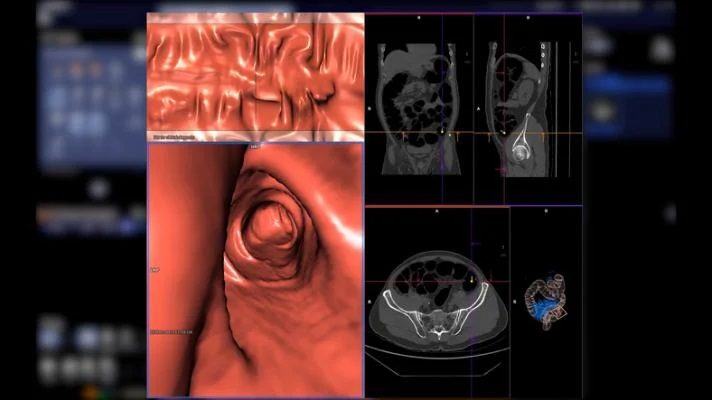 Advancements in CT Colonography Reporting | C-RADS Version 2023