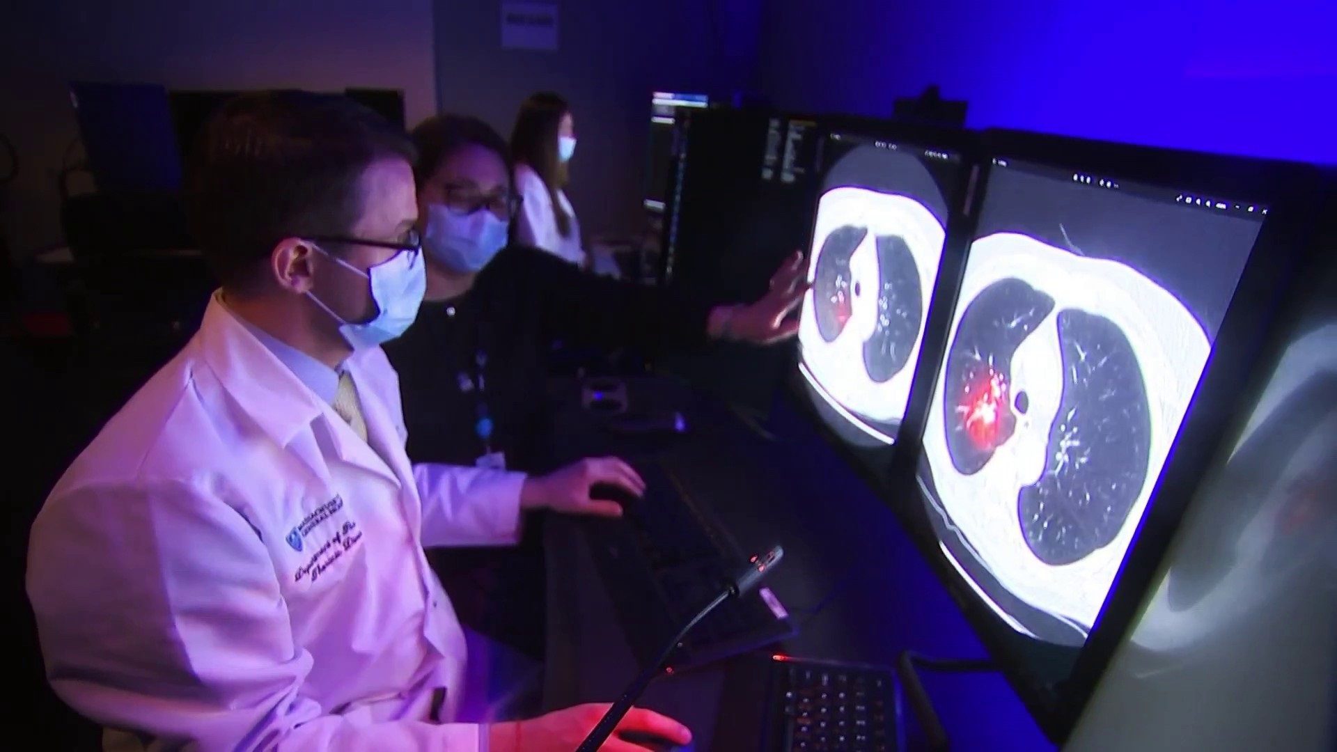 AI-Driven CT Revolutionizes Veteran Lung Cancer Diagnosis