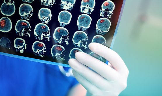 Brainomix receives NICE endorsement for stroke software
