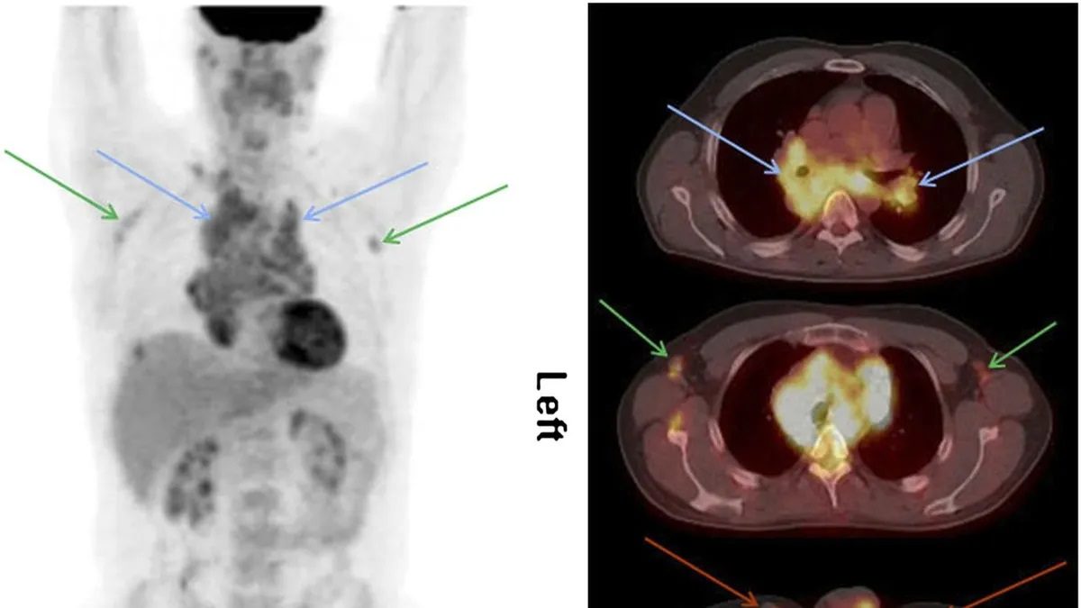 Cutting-Edge PET Tracer Revolutionizes Early Detection of Inflammatory Arthritis