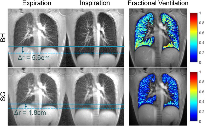 Free-Breathing vs. Breath-Hold MRI Techniques in Ischemic Heart Disease