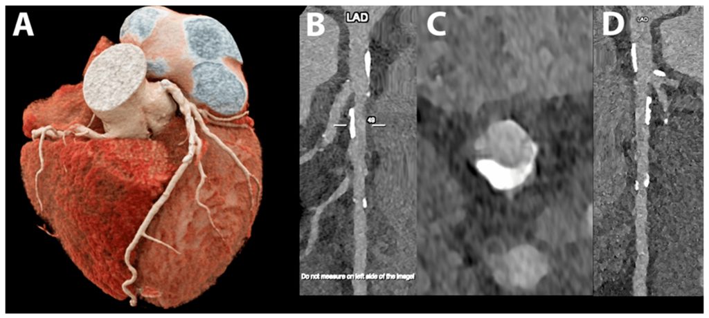 Refining Coronary Artery Disease Assessment with Photon-Counting CT