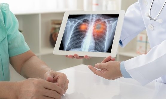 University Hospitals of Leicester goes live with AI reviewed chest x-rays