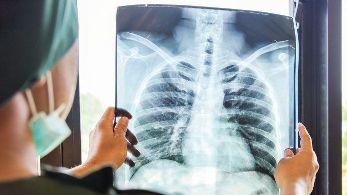 Advancing Lung Disease Diagnosis with Imaging Technology