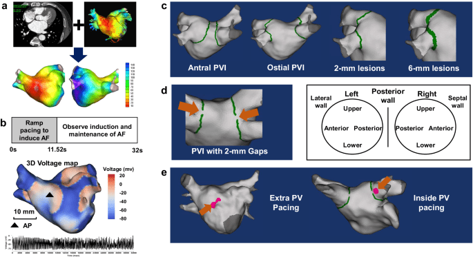 Anti- and pro-fibrillatory effects of pulmonary vein isolation gaps in human atrial fibrillation digital twins