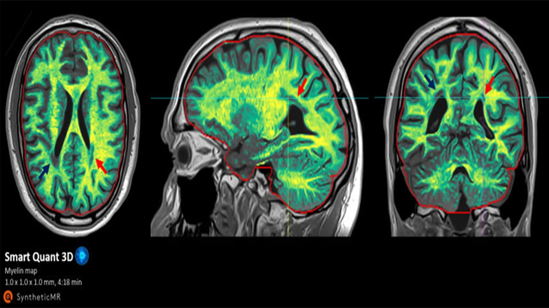 Philips and Synthetic MR Redefine Neurology Imaging