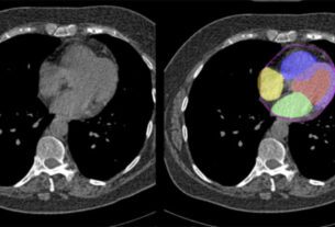 Cedars Sinai Researchers Uses AI to Analyze Regular Chest CT Scans to Predict Heart Disease Risk
