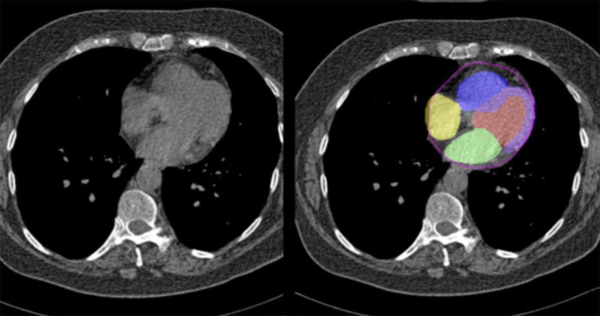 Cedars Sinai Researchers Uses AI to Analyze Regular Chest CT Scans to Predict Heart Disease Risk